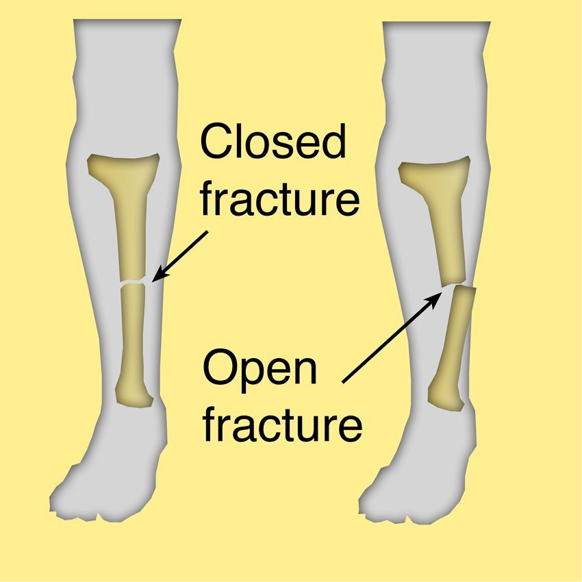 open vs closed fracture